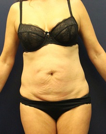 Tummy Tuck Before Photo by Laurence Glickman, MD, MSc, FRCS(c),  FACS; Garden City, NY - Case 34818