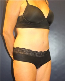 Tummy Tuck After Photo by Laurence Glickman, MD, MSc, FRCS(c),  FACS; Garden City, NY - Case 34818