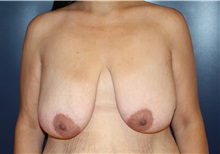 Breast Lift Before Photo by Laurence Glickman, MD, MSc, FRCS(c),  FACS; Garden City, NY - Case 34820