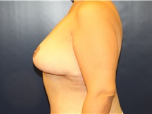 Breast Lift After Photo by Laurence Glickman, MD, MSc, FRCS(c),  FACS; Garden City, NY - Case 34820