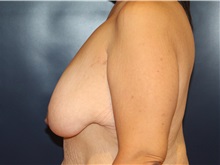 Breast Lift Before Photo by Laurence Glickman, MD, MSc, FRCS(c),  FACS; Garden City, NY - Case 34820