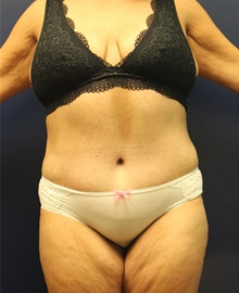 Tummy Tuck After Photo by Laurence Glickman, MD, MSc, FRCS(c),  FACS; Garden City, NY - Case 34822