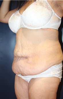 Tummy Tuck Before Photo by Laurence Glickman, MD, MSc, FRCS(c),  FACS; Garden City, NY - Case 34822
