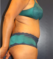 Tummy Tuck After Photo by Laurence Glickman, MD, MSc, FRCS(c),  FACS; Garden City, NY - Case 34824