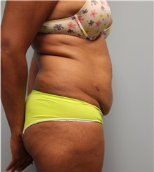 Tummy Tuck Before Photo by Laurence Glickman, MD, MSc, FRCS(c),  FACS; Garden City, NY - Case 34824