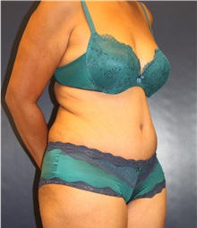 Tummy Tuck After Photo by Laurence Glickman, MD, MSc, FRCS(c),  FACS; Garden City, NY - Case 34824