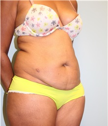 Tummy Tuck Before Photo by Laurence Glickman, MD, MSc, FRCS(c),  FACS; Garden City, NY - Case 34824
