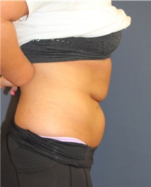Liposuction Before Photo by Laurence Glickman, MD, MSc, FRCS(c),  FACS; Garden City, NY - Case 34828