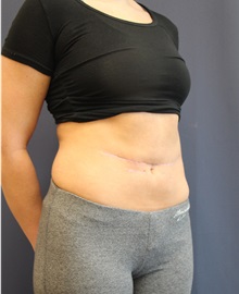 Liposuction After Photo by Laurence Glickman, MD, MSc, FRCS(c),  FACS; Garden City, NY - Case 34828