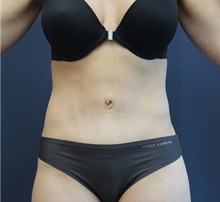 Tummy Tuck After Photo by Laurence Glickman, MD, MSc, FRCS(c),  FACS; Garden City, NY - Case 34831
