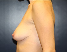 Breast Lift Before Photo by Laurence Glickman, MD, MSc, FRCS(c),  FACS; Garden City, NY - Case 34839