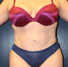 Tummy Tuck After Photo by Laurence Glickman, MD, MSc, FRCS(c),  FACS; Garden City, NY - Case 34853