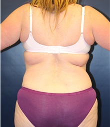 Tummy Tuck Before Photo by Laurence Glickman, MD, MSc, FRCS(c),  FACS; Garden City, NY - Case 34853