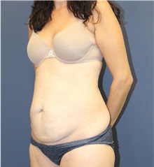Tummy Tuck Before Photo by Laurence Glickman, MD, MSc, FRCS(c),  FACS; Garden City, NY - Case 34857
