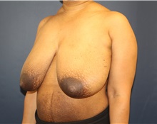 Breast Reduction Before Photo by Laurence Glickman, MD, MSc, FRCS(c),  FACS; Garden City, NY - Case 34858