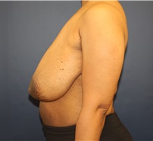 Breast Reduction Before Photo by Laurence Glickman, MD, MSc, FRCS(c),  FACS; Garden City, NY - Case 34858