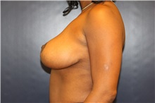 Breast Lift After Photo by Laurence Glickman, MD, MSc, FRCS(c),  FACS; Garden City, NY - Case 34859