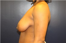 Breast Lift Before Photo by Laurence Glickman, MD, MSc, FRCS(c),  FACS; Garden City, NY - Case 34859