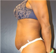 Tummy Tuck Before Photo by Laurence Glickman, MD, MSc, FRCS(c),  FACS; Garden City, NY - Case 34860