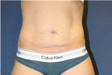 Liposuction Before Photo by Laurence Glickman, MD, MSc, FRCS(c),  FACS; Garden City, NY - Case 34861