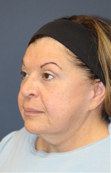 Facelift Before Photo by Laurence Glickman, MD, MSc, FRCS(c),  FACS; Garden City, NY - Case 34862