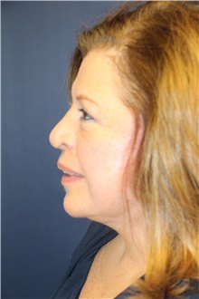 Facelift After Photo by Laurence Glickman, MD, MSc, FRCS(c),  FACS; Garden City, NY - Case 34862