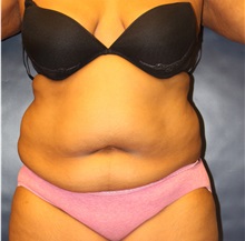 Tummy Tuck Before Photo by Laurence Glickman, MD, MSc, FRCS(c),  FACS; Garden City, NY - Case 34864