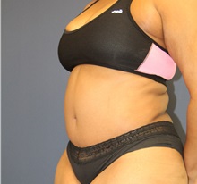 Tummy Tuck After Photo by Laurence Glickman, MD, MSc, FRCS(c),  FACS; Garden City, NY - Case 34864