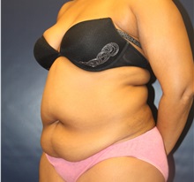 Tummy Tuck Before Photo by Laurence Glickman, MD, MSc, FRCS(c),  FACS; Garden City, NY - Case 34864