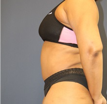 Tummy Tuck After Photo by Laurence Glickman, MD, MSc, FRCS(c),  FACS; Garden City, NY - Case 34864
