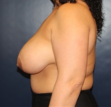 Breast Reduction Before Photo by Laurence Glickman, MD, MSc, FRCS(c),  FACS; Garden City, NY - Case 34866
