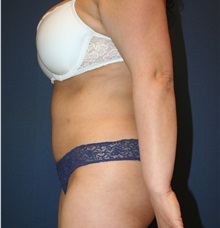 Tummy Tuck After Photo by Laurence Glickman, MD, MSc, FRCS(c),  FACS; Garden City, NY - Case 34867