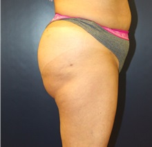 Buttock Lift with Augmentation After Photo by Laurence Glickman, MD, MSc, FRCS(c),  FACS; Garden City, NY - Case 34868