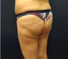 Buttock Lift with Augmentation Before Photo by Laurence Glickman, MD, MSc, FRCS(c),  FACS; Garden City, NY - Case 34868