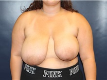 Breast Reduction Before Photo by Laurence Glickman, MD, MSc, FRCS(c),  FACS; Garden City, NY - Case 34870