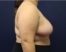 Breast Reduction After Photo by Laurence Glickman, MD, MSc, FRCS(c),  FACS; Garden City, NY - Case 34870