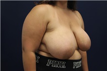Breast Reduction Before Photo by Laurence Glickman, MD, MSc, FRCS(c),  FACS; Garden City, NY - Case 34870