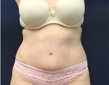 Tummy Tuck After Photo by Laurence Glickman, MD, MSc, FRCS(c),  FACS; Garden City, NY - Case 34872