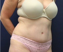 Tummy Tuck After Photo by Laurence Glickman, MD, MSc, FRCS(c),  FACS; Garden City, NY - Case 34872
