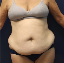 Tummy Tuck Before Photo by Laurence Glickman, MD, MSc, FRCS(c),  FACS; Garden City, NY - Case 34873
