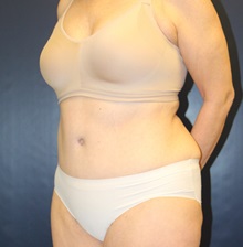 Tummy Tuck After Photo by Laurence Glickman, MD, MSc, FRCS(c),  FACS; Garden City, NY - Case 34873
