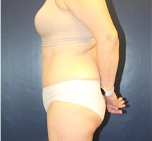 Tummy Tuck After Photo by Laurence Glickman, MD, MSc, FRCS(c),  FACS; Garden City, NY - Case 34873