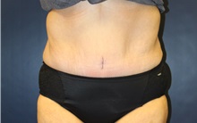 Tummy Tuck After Photo by Laurence Glickman, MD, MSc, FRCS(c),  FACS; Garden City, NY - Case 34874