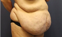 Tummy Tuck Before Photo by Laurence Glickman, MD, MSc, FRCS(c),  FACS; Garden City, NY - Case 34874