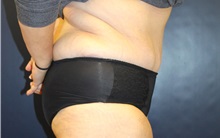 Tummy Tuck After Photo by Laurence Glickman, MD, MSc, FRCS(c),  FACS; Garden City, NY - Case 34874