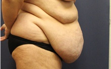 Tummy Tuck Before Photo by Laurence Glickman, MD, MSc, FRCS(c),  FACS; Garden City, NY - Case 34874