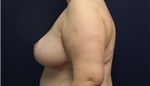 Breast Reduction After Photo by Laurence Glickman, MD, MSc, FRCS(c),  FACS; Garden City, NY - Case 34875