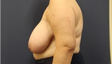 Breast Reduction Before Photo by Laurence Glickman, MD, MSc, FRCS(c),  FACS; Garden City, NY - Case 34875