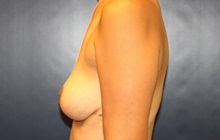 Breast Lift After Photo by Laurence Glickman, MD, MSc, FRCS(c),  FACS; Garden City, NY - Case 34913
