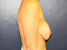 Breast Lift Before Photo by Laurence Glickman, MD, MSc, FRCS(c),  FACS; Garden City, NY - Case 34913